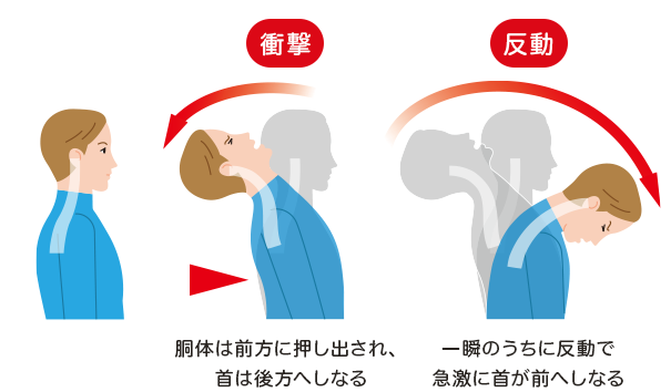 むち打ち症はどのように診断されますか?