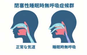 睡眠時無呼吸症候群 治療のイメージ図解