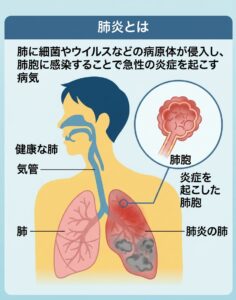肺炎とは　図解